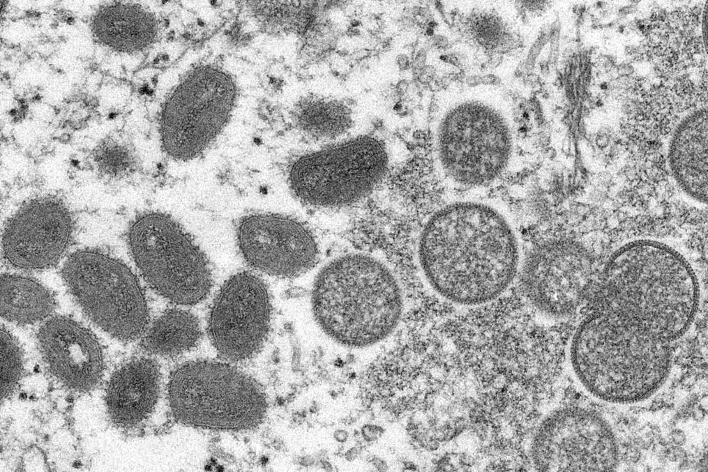 A Massachusetts Man Is Infected With Monkeypox
