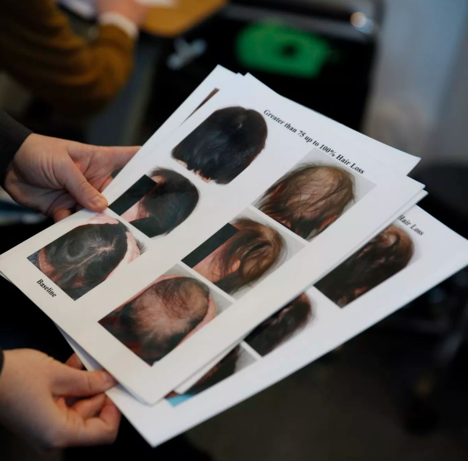 F.D.A. Approves Alopecia Drug That Restores Hair Growth in Many Patients
