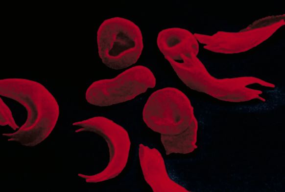 Sickle-Cell Treatment Created With Gene Editing Wins U.K. Approval